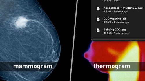 FDA: Breast Cancer Screening – Thermogram No Substitute for Mammogram