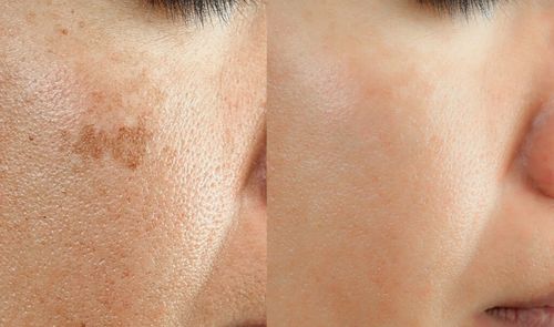 FDA Upgrades Warning On Illegal Skin Lightening Products To Class I — Mercury Levels Found Thousands Of Times Above Safe Limits